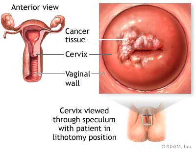 cervical-cancer2